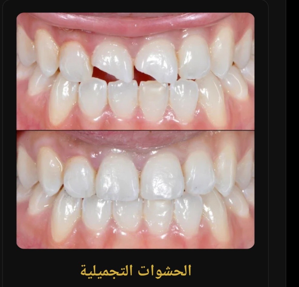 حالة تجميل الأسنان قبل العلاج وبعده
