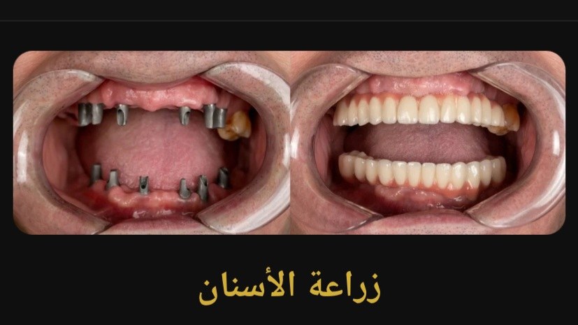 حالة زراعة الأسنان قبل العلاج وبعده