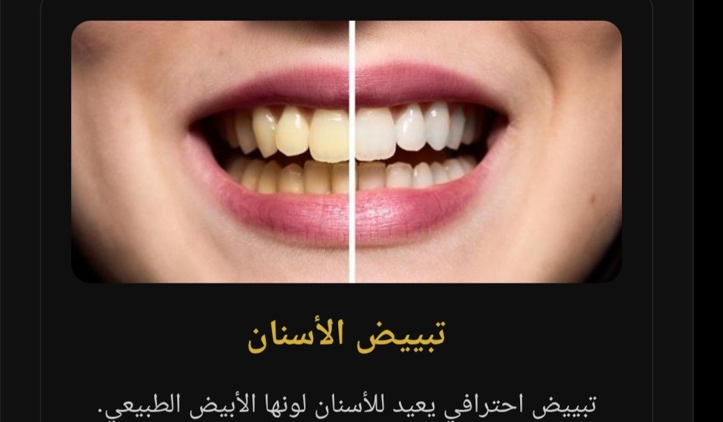 صورة توضيحية لمقارنة لون الأسنان قبل التبييض وبعده